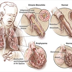 Cough Bacteria Or Virus 