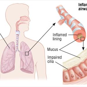 Chronic Bronchitis Prognosis - Smoking Cessation - 4 Reasons Why You Absolutely Need To Quit Today!