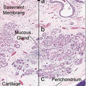 Beat Bronchitis Naturally - Bronchitis Causes, Symptoms And Treatment