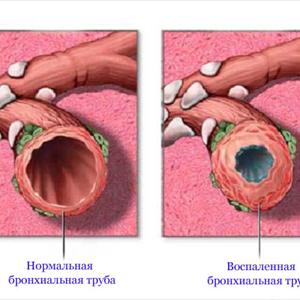 Bronchial Infection Cure - Herbal Vaporizer Weed For Treating Many Ailments