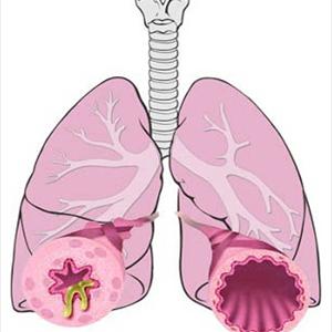 Persistent Cough Hard To Breath - Causes Of Bronchitis