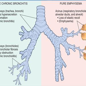  Treatment Of Bronchitis