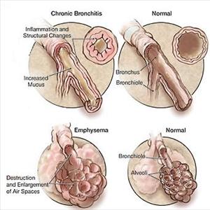 Bronchitis Antibiotics - Your Kids And Bronchitis