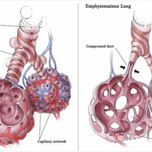 Belladonna Treatment Bronchitis - Asthmatic Bronchitis