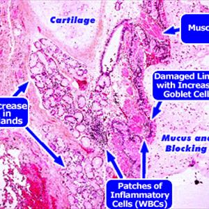 Herbs For Bron - Basic Signs Of Acute Bronchitis