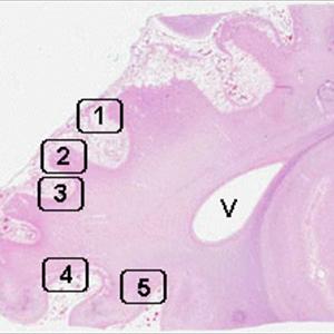 Alternative Bronchitas Cures - Types Of Lung Cancer