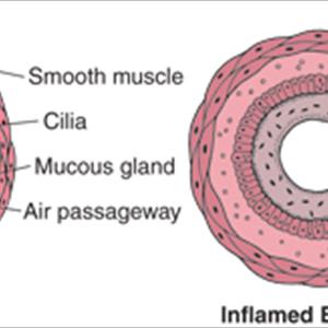 Bronchitis Lung - Useful Pointers In Looking For Treatment Of Chronic Bronchitis