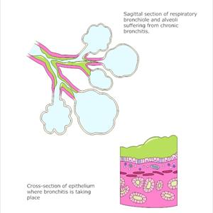 Cough And Chest Burn - An Overview Of Acute Asthmatic Bronchitis