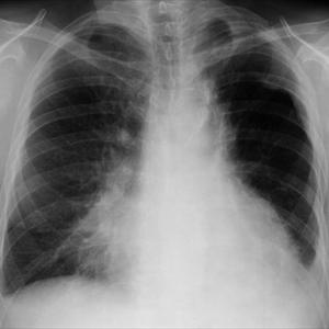 Herbs Bronchitis 