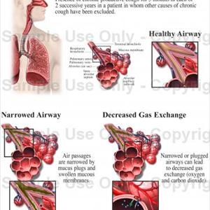 Silphur Drug For Bronchitis 