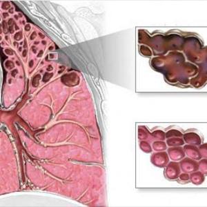 Bronovil Order - Lobelia Inflata Benefits Those With Pneumonia