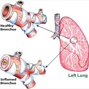 Bronchial Infections - Causes - Bacterial Might Be The Cause Of Bronchitis