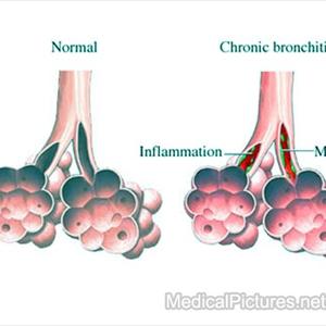 Trachial Bronchitis - Using NLP To Beat COPD