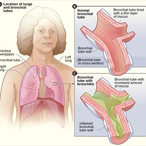 Bronchi - Symptoms Of Bronchitis And Its Causes