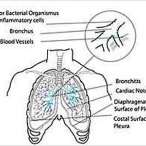 Elimating Coughing Up Phlegm - Smoking Facts And Why You Should Quit