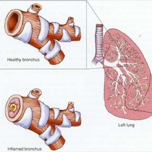 Acute Bronchitis Symptoms - AIRWAY Clearance For CHRONIC BRONCHITIS