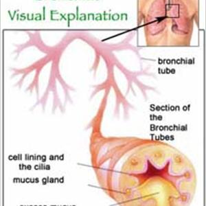 Bronchitis Infectious - Suggestions Of Precautions For Allergic Children To Better Health