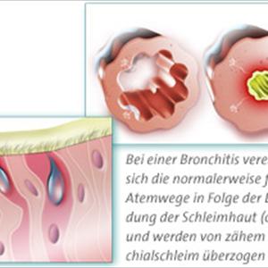 Best Antibiotic For Bronchitis Cough - Flavored E Cigarette Cartridges - You Can Stop Nicotine Wanting And Give Up Smoking Now!