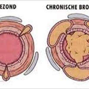 Bronchitis Medicine - Natural Bronchitis Treatments 6 Natural Bronchitis Treatment Tips You Can Do Yourself