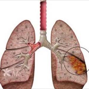 Cause Of Morning Chest Congestion 