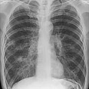  Acute Bronchitis Symptoms: Cough, Fever, Chest Pain, & More