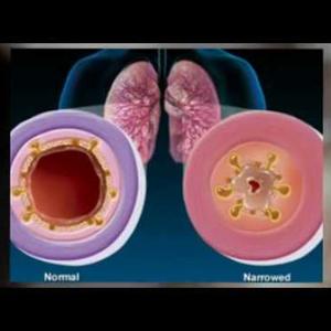  Common Medicine To Fight Bronchitis