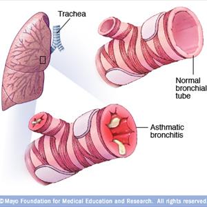 Herbel Treatment For Bacterial Brochitis 