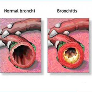 Catarrh Cures - Smoking Side Effects Its More Than Just Bad For You