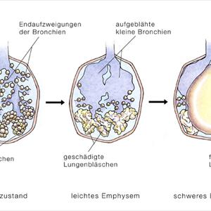 Treatment For Broncitis - Bronchitis Medication